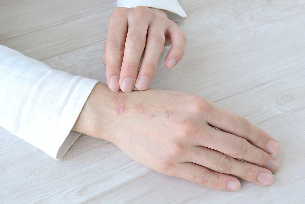 アトピー性皮膚炎の画像
